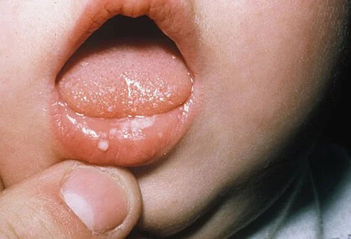 Kandidiasis